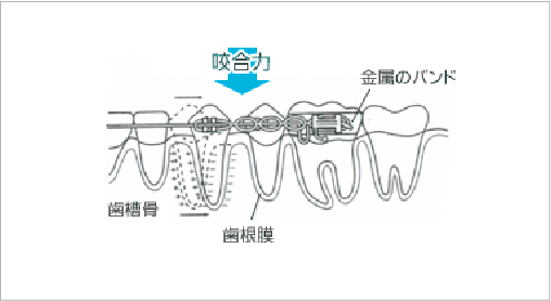 矯正治療のメカニズムの図